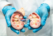 La insuficiencia renal es una enfermedad catastrófica en México